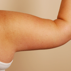 Compare Before & After Photos of _procedure_photos.phpArm Lift