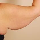 Compare Before & After Photos of _procedure_photos.phpArm Lift
