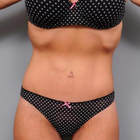 Compare Before & After Photos of _procedure_photos.phpBody Lift