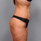 Compare Before & After Photos of _procedure_photos.phpBody Lift