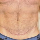 Compare Before & After Photos of _procedure_photos.phpBody Lift