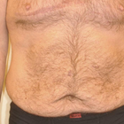 Compare Before & After Photos of _procedure_photos.phpBody Lift