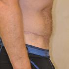 Compare Before & After Photos of _procedure_photos.phpBody Lift