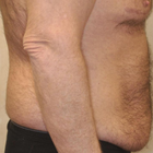 Compare Before & After Photos of _procedure_photos.phpBody Lift