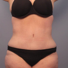 Compare Before & After Photos of _procedure_photos.phpBody Lift