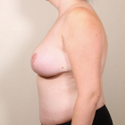 Compare Before & After Photos of _procedure_photos.phpBreast Lift