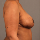 Compare Before & After Photos of _procedure_photos.phpBreast Lift