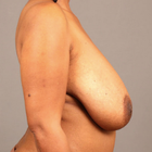 Compare Before & After Photos of _procedure_photos.phpBreast Lift