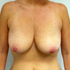 Compare Before & After Photos of _procedure_photos.phpBreast Reduction