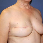 Compare Before & After Photos of _procedure_photos.phpBreast Reconstruction