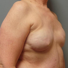 Compare Before & After Photos of _procedure_photos.phpBreast Reconstruction