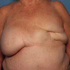 Compare Before & After Photos of _procedure_photos.phpBreast Reconstruction