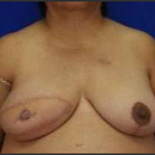 Compare Before & After Photos of _procedure_photos.phpBreast Reconstruction