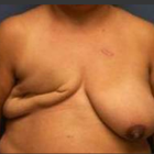 Compare Before & After Photos of _procedure_photos.phpBreast Reconstruction