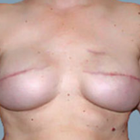 Compare Before & After Photos of _procedure_photos.phpBreast Reconstruction