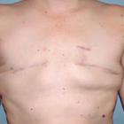 Compare Before & After Photos of _procedure_photos.phpBreast Reconstruction