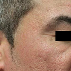 Compare Before & After Photos of _procedure_photos.phpLaser Tattoo Removal