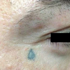 Compare Before & After Photos of _procedure_photos.phpLaser Tattoo Removal