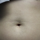 Compare Before & After Photos of _procedure_photos.phpLaser Tattoo Removal