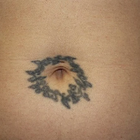 Compare Before & After Photos of _procedure_photos.phpLaser Tattoo Removal