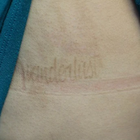 Compare Before & After Photos of _procedure_photos.phpLaser Tattoo Removal