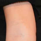 Compare Before & After Photos of _procedure_photos.phpLaser Tattoo Removal