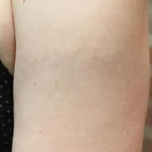 Compare Before & After Photos of _procedure_photos.phpLaser Tattoo Removal