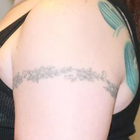Compare Before & After Photos of _procedure_photos.phpLaser Tattoo Removal
