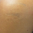 Compare Before & After Photos of _procedure_photos.phpLaser Tattoo Removal