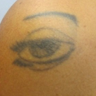 Compare Before & After Photos of _procedure_photos.phpLaser Tattoo Removal