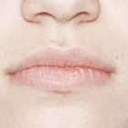 Compare Before & After Photos of _procedure_photos.phpLaser Hair Removal