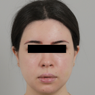 Compare Before & After Photos of _procedure_photos.phpJaw Shaping