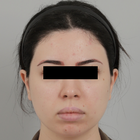 Compare Before & After Photos of _procedure_photos.phpJaw Shaping