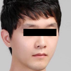 Compare Before & After Photos of _procedure_photos.phpJaw Shaping