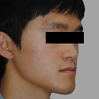 Compare Before & After Photos of _procedure_photos.phpJaw Shaping