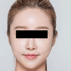 Compare Before & After Photos of _procedure_photos.phpJaw Shaping