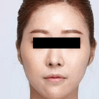 Compare Before & After Photos of _procedure_photos.phpJaw Shaping