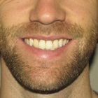 Compare Before & After Photos of _procedure_photos.phpJaw Shaping