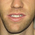 Compare Before & After Photos of _procedure_photos.phpJaw Shaping