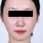 Compare Before & After Photos of _procedure_photos.phpJaw Shaping