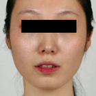 Compare Before & After Photos of _procedure_photos.phpJaw Shaping