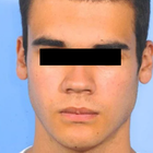 Compare Before & After Photos of _procedure_photos.phpJaw Shaping