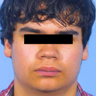 Compare Before & After Photos of _procedure_photos.phpJaw Shaping