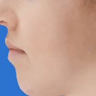 Compare Before & After Photos of _procedure_photos.phpJaw Shaping