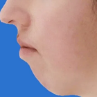 Compare Before & After Photos of _procedure_photos.phpJaw Shaping