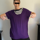 Compare Before & After Photos of _procedure_photos.phpGastric Bypass Surgery