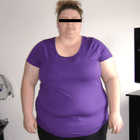 Compare Before & After Photos of _procedure_photos.phpGastric Bypass Surgery