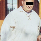 Compare Before & After Photos of _procedure_photos.phpGastric Bypass Surgery