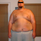 Compare Before & After Photos of _procedure_photos.phpGastric Bypass Surgery