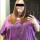 Compare Before & After Photos of _procedure_photos.phpGastric Bypass Surgery